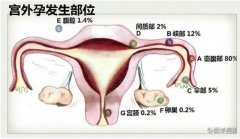 “宫外孕”是什么？